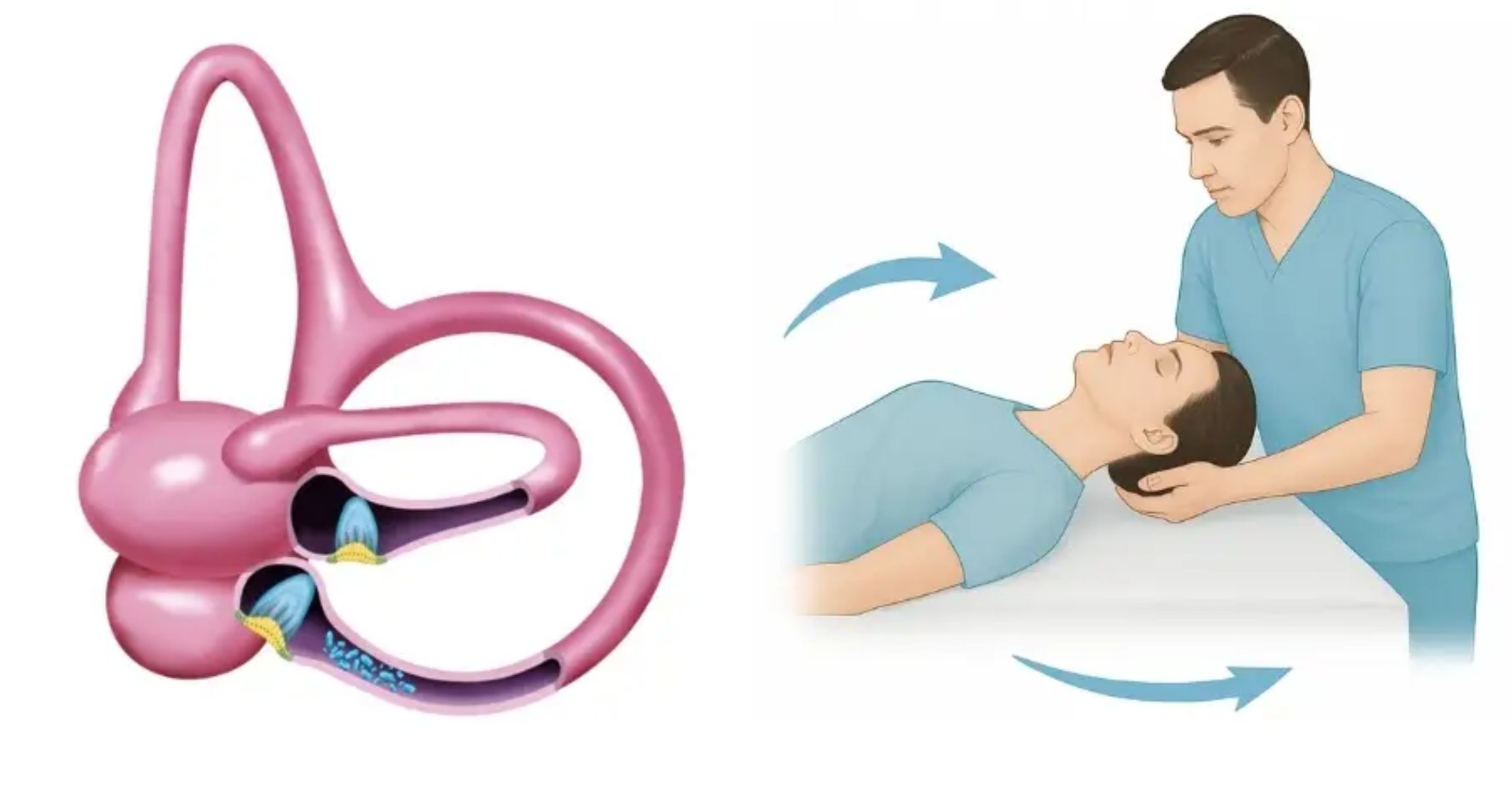 Vertigo VNG BPPV